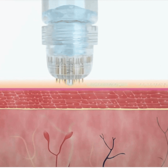 Micro-Infusion Anti Wrinkles + Free Serum Included